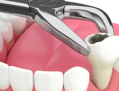 How To Choose The Right Periosteal Elevator For Dental Procedures
