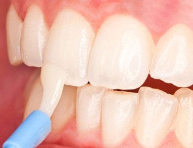Fluoride Treatment: The Most Effective Cavity Shield 