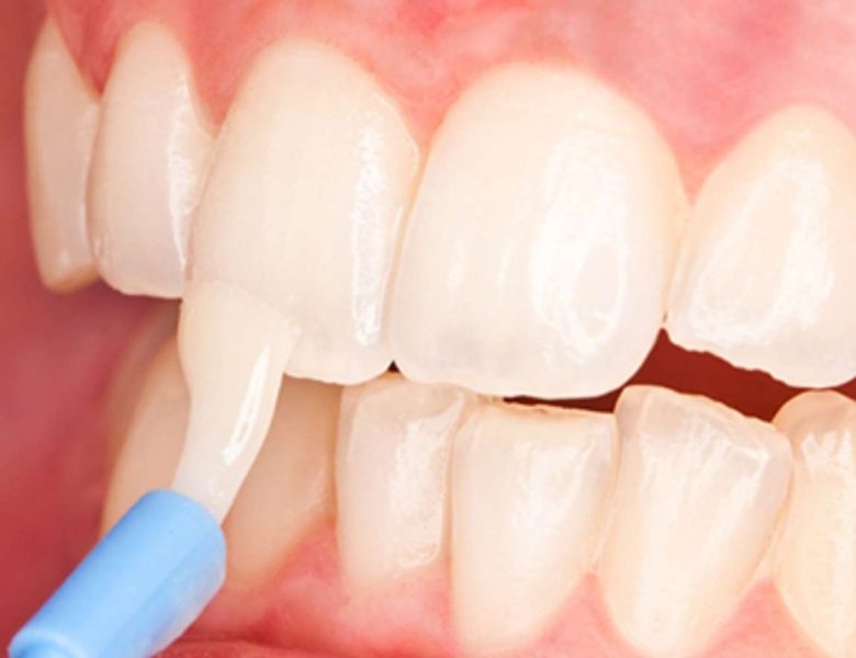 Fluoride Treatment: The Most Effective Cavity Shield 