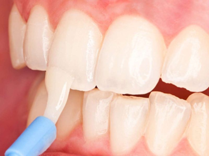 Fluoride Treatment: The Most Effective Cavity Shield 